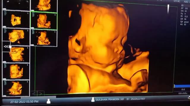 DOWN SYNDROME I ANOMALY SCAN I LEVEL II смотреть онлайн