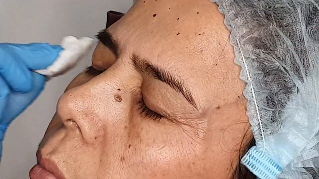 Пешона ва куз атрофи, ажинларга ботекс