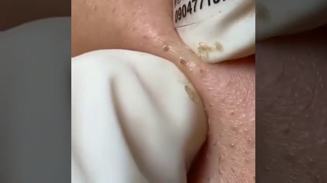 Top best Pimple popping TikTok Videos Compilation #2 смотреть онлайн