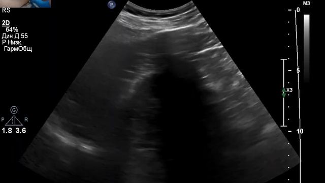 Во время УЗИ брюшной полости выявлен стеноз почечной артерии. Как заподозрить? смотреть онлайн