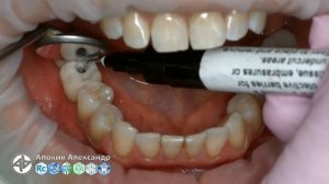 Винтовая фиксация коронок с опорой на имплнты DIO 36 37 46 47 (прямой эфир)