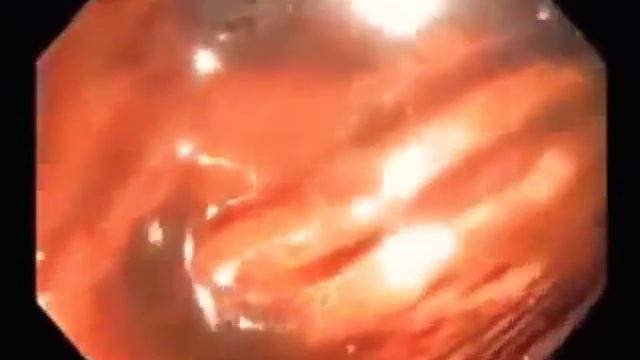 Кишечник здоровый и больной смотреть онлайн