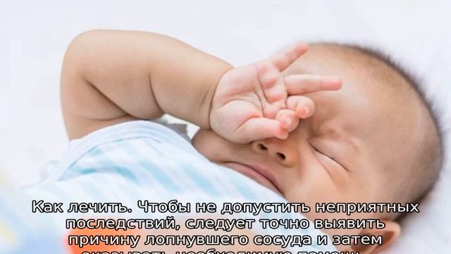 Лопнул сосуд в глазу у ребенка — возможные причины, что делать смотреть онлайн