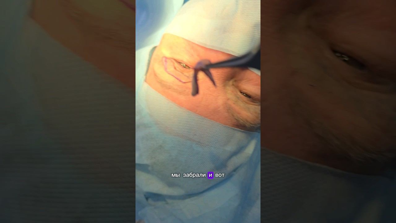 что с ней сделали???    #пластическийхирург #пластика #блефаропластика