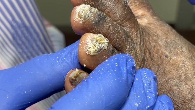 SUPER LARGE FUNGAL TOENAILS (INCREDIBLE TRANSFORMATION) смотреть онлайн