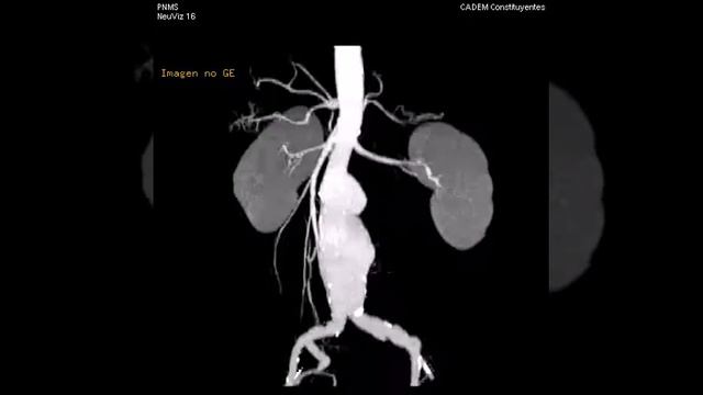 Ct Angio Aorta Abdominal VR 9 смотреть онлайн