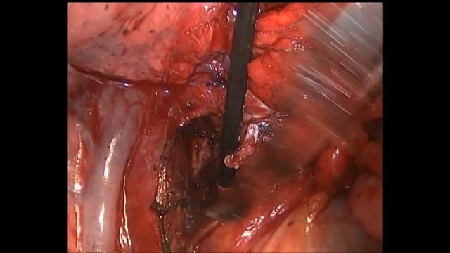 Mediastinal lymph node dissection via mini anterior thoracotomy смотреть онлайн
