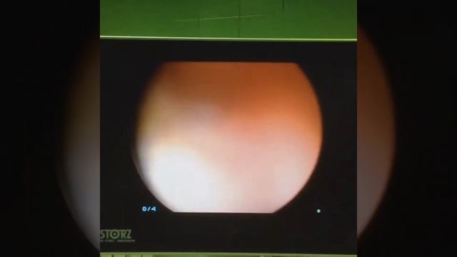 Percutaneos nephrolihtotomy left_K3 смотреть онлайн