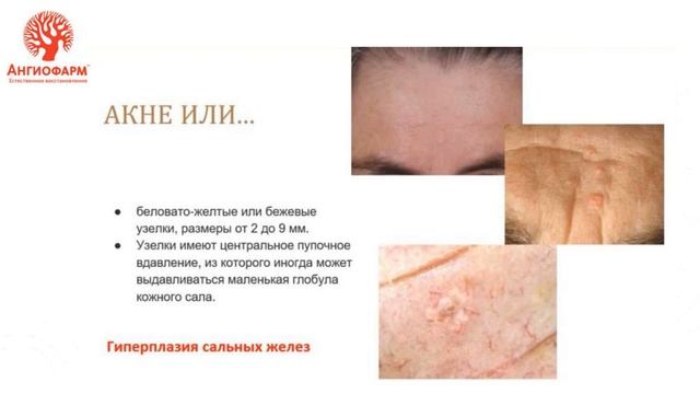 Розацеа, современные представления о патогенезе, клинической картине и методах коррекции смотреть онлайн