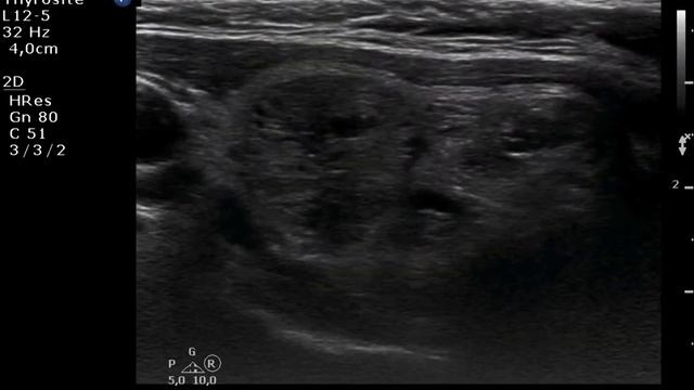 Nodule 3 - study on intranodular hyperechogenic figures смотреть онлайн