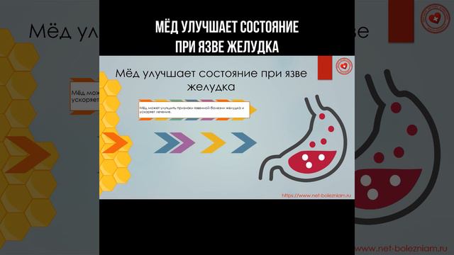 Мёд улучшает состояние при язве желудка #мёд #язважелудка #язва #народнаямедицина смотреть онлайн