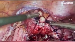 Лапароскопическая коррекция пролапса с гистерэктомией