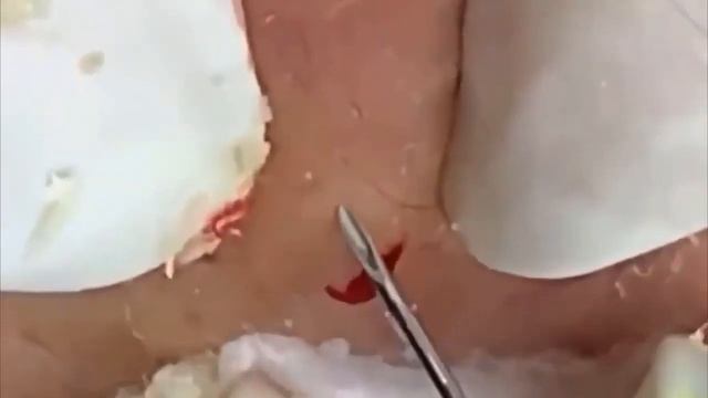 Выдавливание Прыщей   выдавливание черных точек. मुँहासे निचोड़ने वाले ब्लैक डॉट्स को निचोड़ना