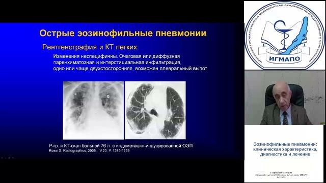 Эозинофильные пневмонии. Черняк БА.mp4