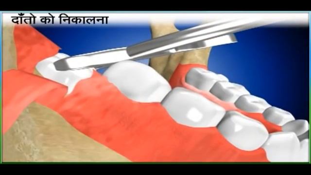 दांतों को निकालना (Tooth Extraction Aftercare) Dr Somit Jain II Hindi 2021 (4K VIDEO) смотреть онлайн