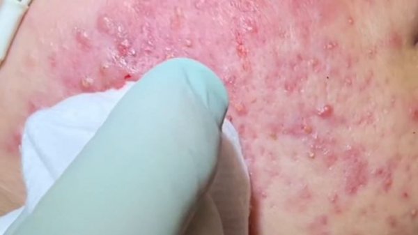 So much pop! Acne extractions on severe inflammatory acne. Multiple blackheads and whiteheads.