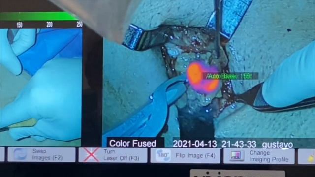 Sentinel lymph node with voiceover смотреть онлайн
