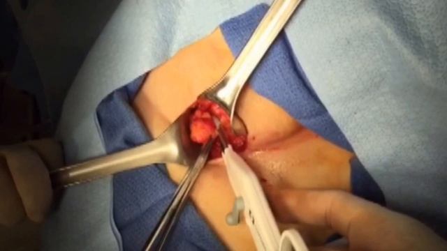 Sentinel Lymph Node Biopsy смотреть онлайн