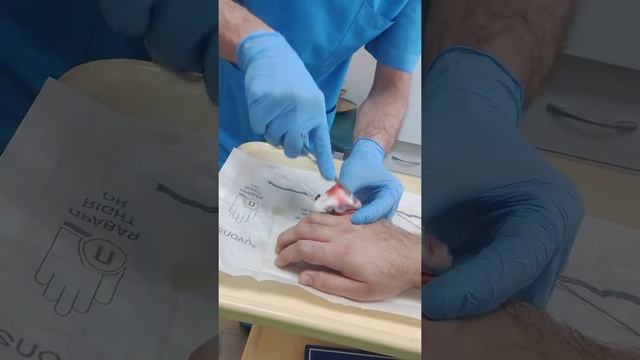 извлечение спиц из кисти после перелома костей кисти смотреть онлайн