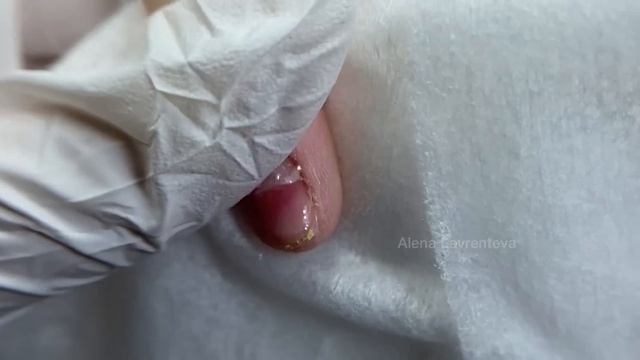 ОСТАЛАСЬ БЕЗ НОГТЯ / ТРАВМА НОГТЯ / ОНИХОЛИЗИС / ЧТО ДЕЛАТЬ? ОНИХОЛИЗИС ЭТО СТРАШНО? СОРВАЛА НОГОТЬ смотреть онлайн