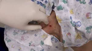 Пункция и катетеризация внутренней яремной вены