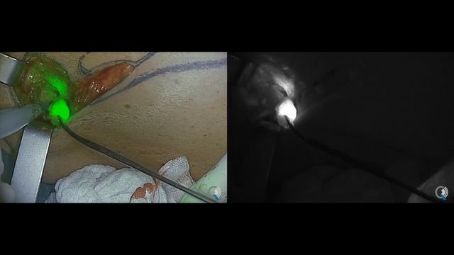 SLN Detection in Breast Tissue смотреть онлайн