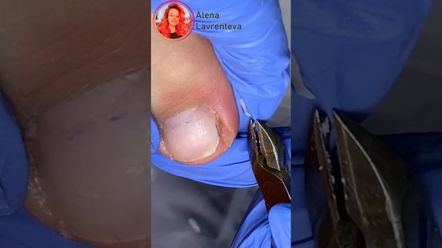 Полное видео на канале! Вросший ноготь на ноге! #nails смотреть онлайн