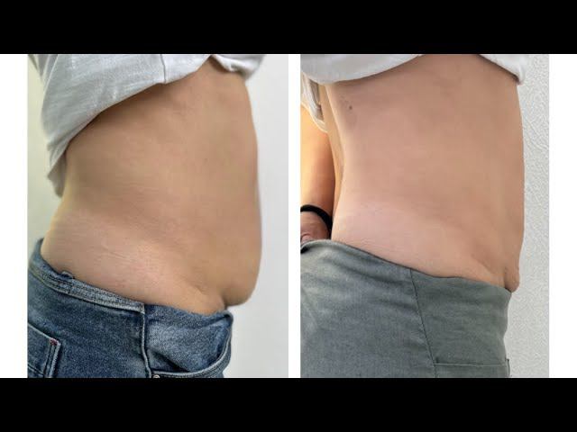 - 9см за 20 дней. Похудение без диет.