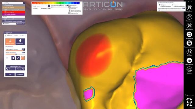 Exocad + Medit i500 intraoral scanner: single crown case смотреть онлайн