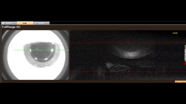 Ретролентальное помутнение стекловидного тела смотреть онлайн