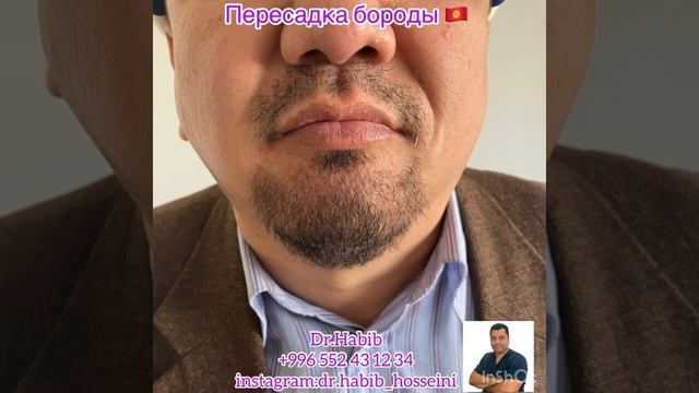Пересадка бороды смотреть онлайн