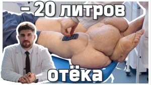 Клинический случай: пациент с лимфостазом