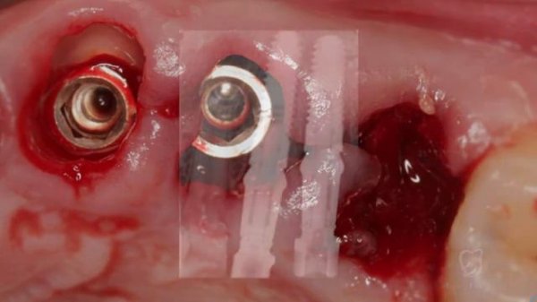 Dişyuvasının qorunması texnikası diş kökünün bir hissəsini saxlamaqla İMPLANTOLOQ Dr. EMİL İMANOV