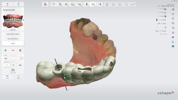 Same-day implant dentistry with 3Shape Implant Studio 2019