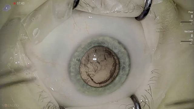 B+L Luxsmart EDOF Anton Angelov Vista Live Stream смотреть онлайн