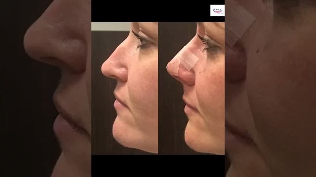 Rinoplastia PITANGUY смотреть онлайн