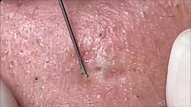 Relaxing Acne Treatment Acnes Treatment 133 смотреть онлайн