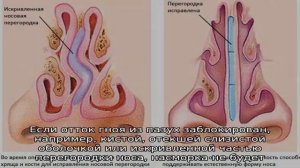 Как лечить заложенный нос без соплей