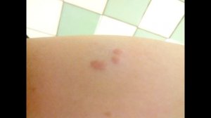 Чем вылечить лишай