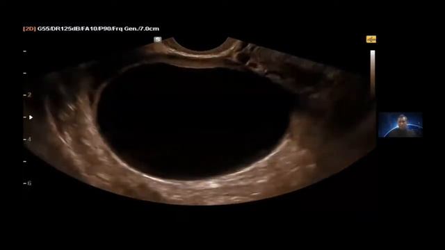 EVALUACIÓN DEL OVARIO NORMAL Y PATOLÓGICO. CLASIFICACIÓN GI-RADS. DR. ARTEMIO MARTINEZ смотреть онлайн