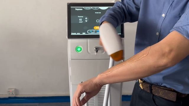 Лазерная эпиляция на аппарате Soprano с технологией Titanium смотреть онлайн