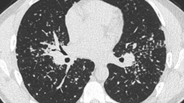 Difference Between Sarcoidosis and Tuberculosis смотреть онлайн