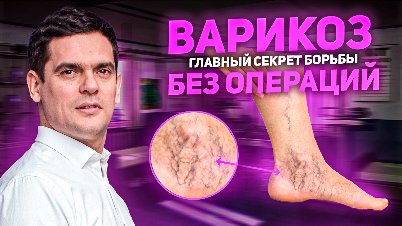 Варикозное Расширение Вен. Просты Действия, Которые Помогут Вам Избавиться от Варикоза смотреть онлайн