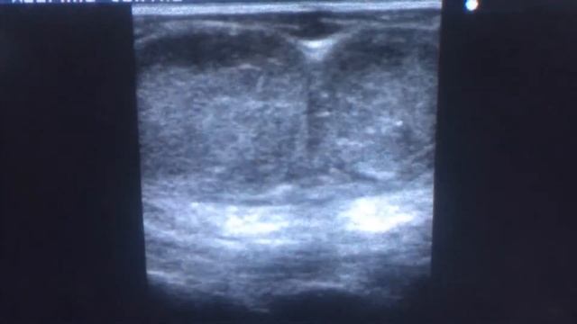 Usg metastatic cervical lymph nodes unknown primary смотреть онлайн