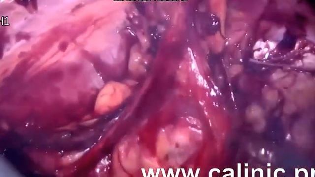 Лапароскопическая герниопластика паховой грыжи в Омске смотреть онлайн