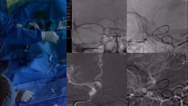 Stent anchor technique to reduce microcatheter loop for stent-assisted coiling of ACA aneurysm смотреть онлайн