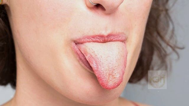 Если заметили белый налет на языке то сделайте так! Что значит белый налет на языке? смотреть онлайн