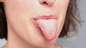 Если заметили белый налет на языке то сделайте так! Что значит белый налет на языке?