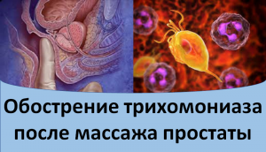 Обострение трихомониаза после массажа простаты.