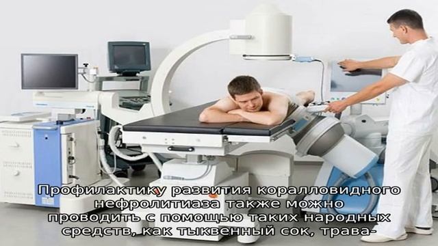 Коралловидные камни в почках смотреть онлайн